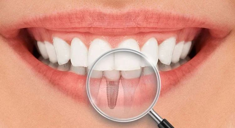 Ilustração de implante dentário