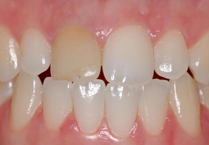 Exemplo de dente escurecido