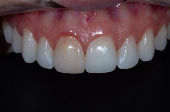Correção de cor em dente com resina após trauma
