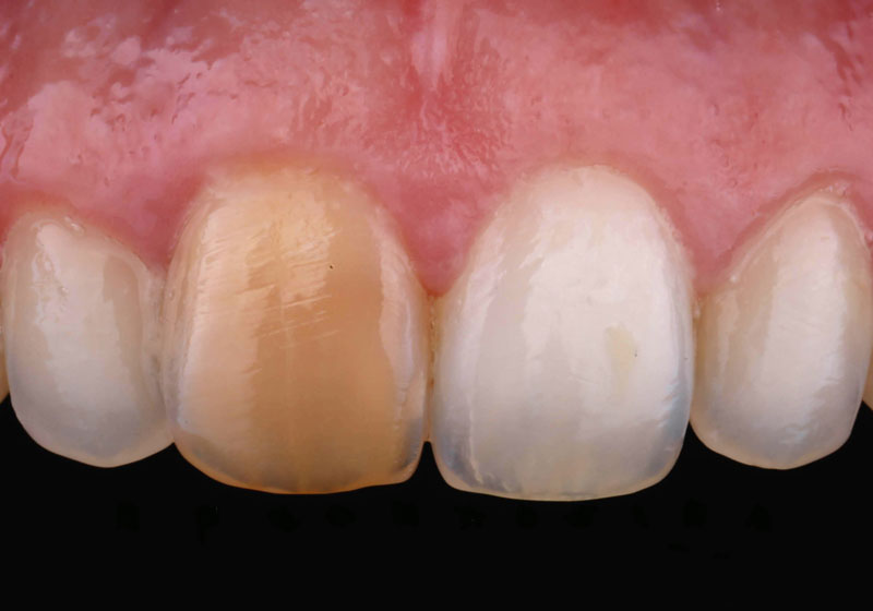 Reabilitação de dente com necrose pulpar